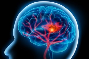 How to recognize the signs of a stroke